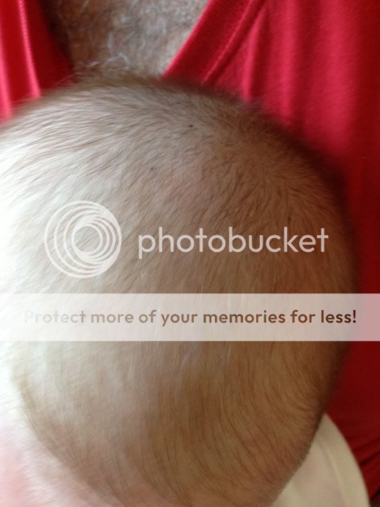 black-spots-on-lo-s-head-babycenter